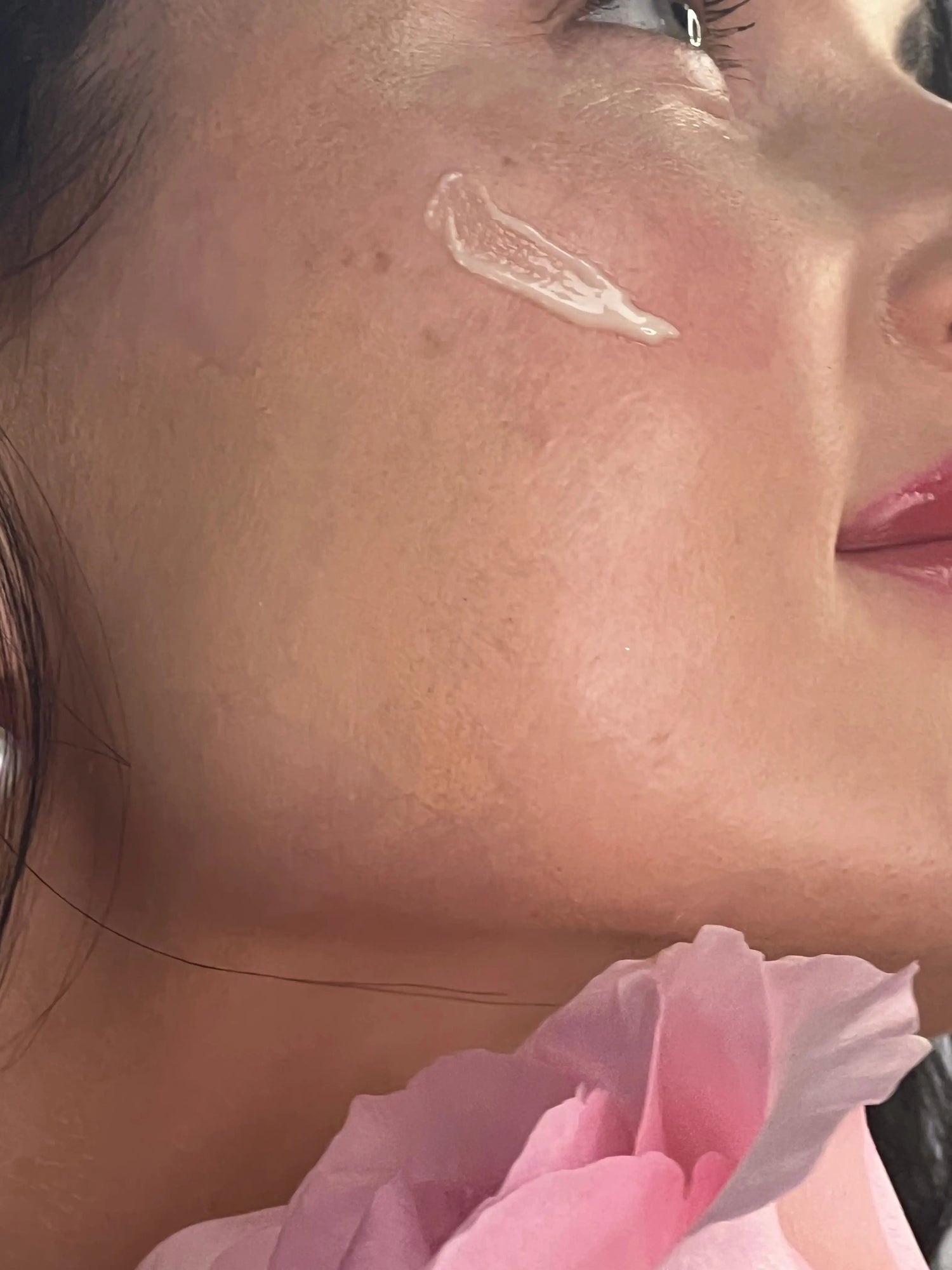 Hyperpigmentation/ Melasma