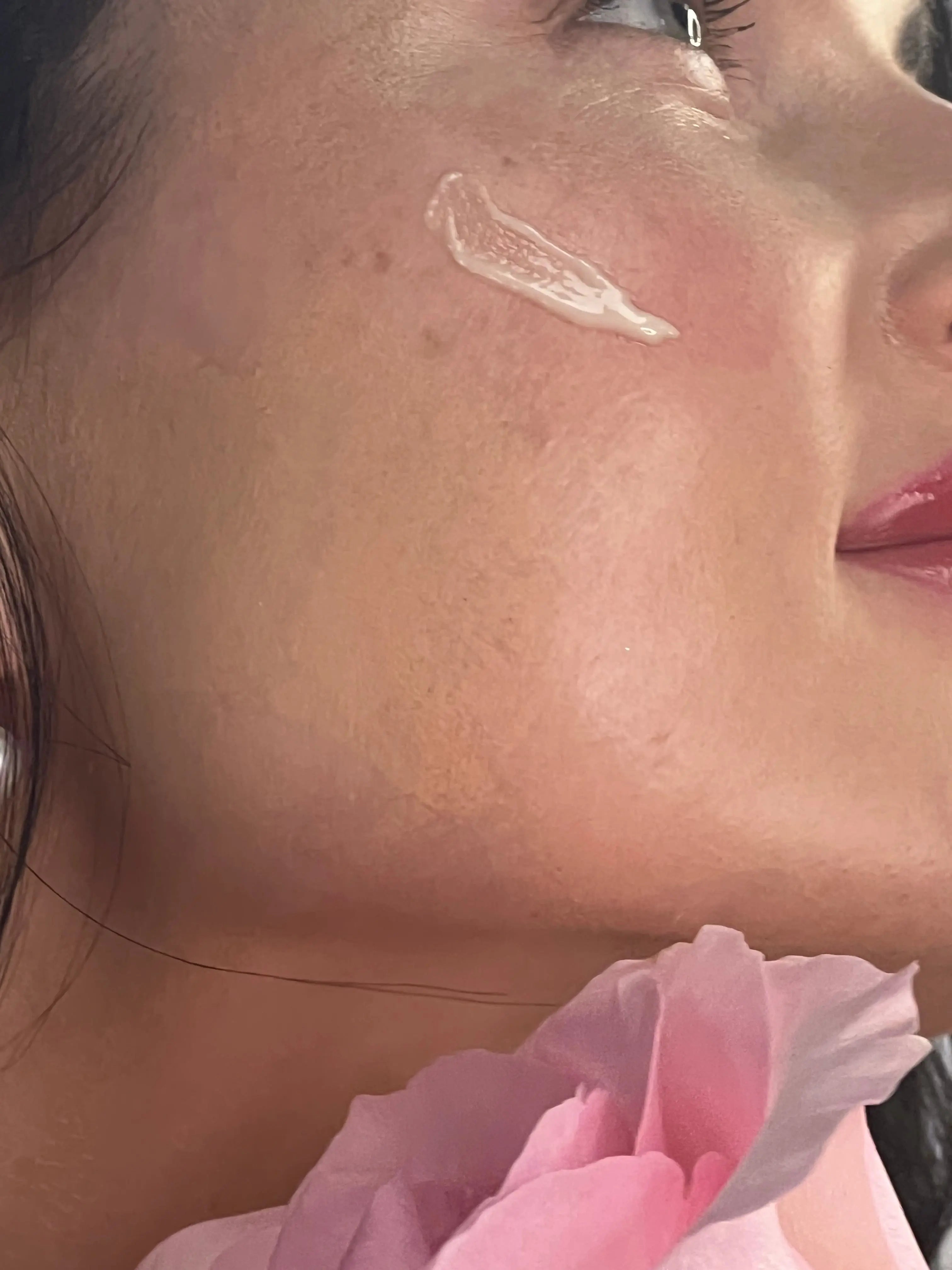 Hyperpigmentation/ Melasma